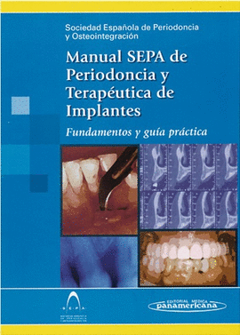 MANUAL SEPA DE PEIODONCIA Y TERAPEUTICA DE IMPLANTES